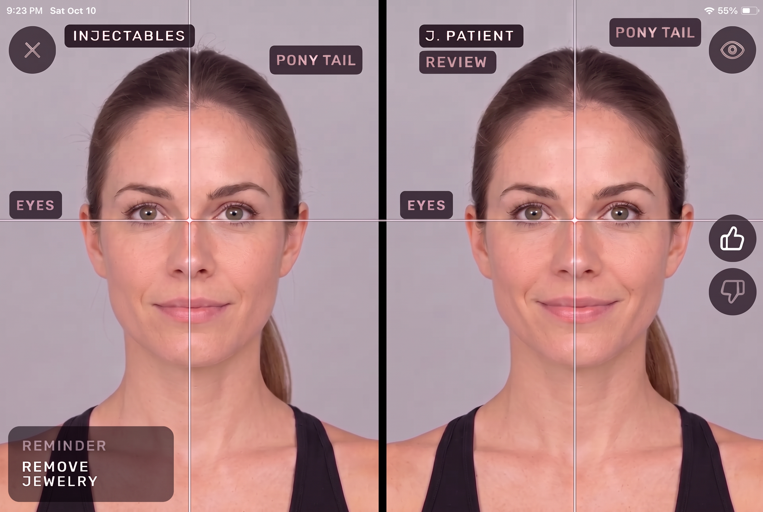 ALIGN before and after photo app on iPad showing two matched patient portraits with alignment guides, procedure tags and a remove jewelry reminder